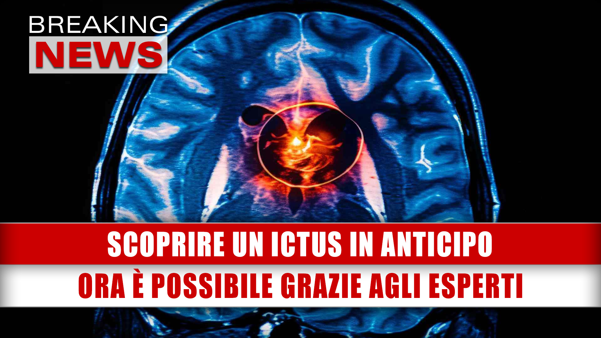 Scoprire Un Ictus In Anticipo: Ora È Possibile Grazie Agli Esperti!